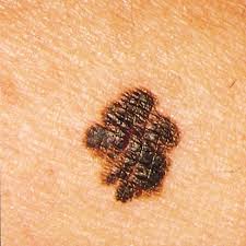 Basal cell carcinoma is more common in patients with fair skin, especially after prolonged sun exposure, frequent tanning, and other risk factors. How To Spot Skin Cancer