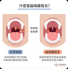 扁桃 腺 肥大 手術 費用