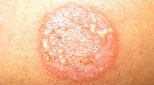 দাদ এর চিকিৎসা এর ছবির ফলাফল