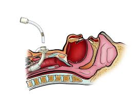 Image result for Tracheostomy