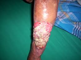 A case of hypertensive ulcer of martorell in a diabetic patient is described standing out the fast cure by means of hyperbaric oxygenotherapy. Marjolin S Ulcer Wikipedia