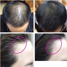 Hair loss has a tendency of making individuals extremely conscious of their appearance. Lcd Display Laser Therapy Hair Growth Regrowth Cap Excelsior Wellness Wellness Haircare Hairlosstreatment Health Laser Therapy Hair Laser Growth Regrowth