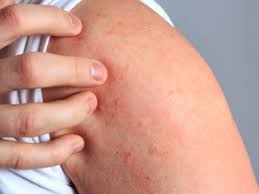 Ekzeme Erkennen Symptome Lindern Bepanthen