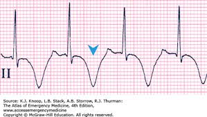 Image result for T Wave