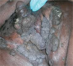 Image result for genital warts