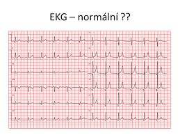 Embolizace plic se však může stát i uvolněným vmetkem z jiné části těla, a také k tomu může dojít i u doposud. Bolest Na Prsou Na Hrudi Ppt Stahnout