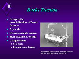 And lastly, the comfort of the patient should be maintained, and making sure he/she is comfortable in his/her position to avoid any further complications. Key Concepts In The Care Of Patients In Traction Ppt Download