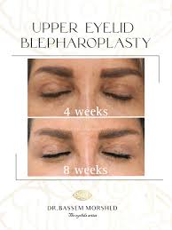 Worried about scars after eyelid surgery? In upper eyelid blepharoplasty,  the incision is placed carefully along the natural crease of the eyelid,  making it almost invisible once healed. Healing varies between one