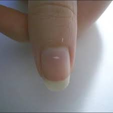 Nail Clinic Leukonychia Nail Health Nailpro White Spots On Nails Nail Health White Marks On Nails