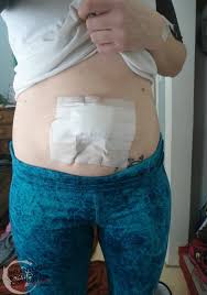 Adventures With Umbilical Hernia Surgery The First 72 Hours Umbilical Hernia Umbilical Hernia Repair Surgery Recovery