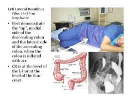 Check spelling or type a new query. Radiographic Positioning For Barium Enema Presented By Aries