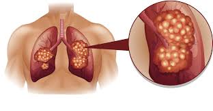 Most signs of leukemia happen because the cancer cells keep your healthy. Blood Test Lung Cancer Ramsay Health Uk
