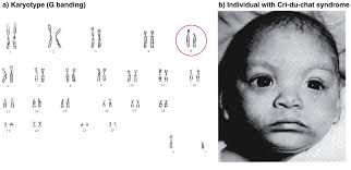 Cri du chat syndrome is a rare genetic disorder due to a partial chromosome deletion on chromosome 5. Ø£Ø±Ø´Ù€Ø¯Ù†Ù€ÙŠ On Twitter Cri Du Chat Syndrome Crying