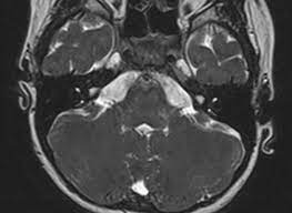 Large Vestibular Aqueduct Syndrome Radiology Case Radiopaedia Org
