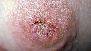 This form of cancer results in the blockage of lymph vessels in the skin. Breast Cancer Dimpling Tips For Identification