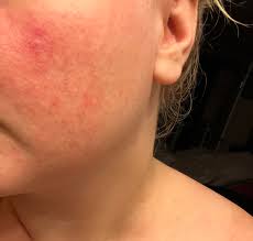So can you please help me.I have trying the La Roche posay effaclar duo and  it doesn't work or the Niacinamide serum and it didn't work also it broke  me out. Right