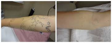 Laser tattoo removal is generally safe when performed by a qualified technician or doctor. Laser Tattoo Removal Before After Photos Novi Troy Mi