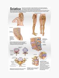 Medical Chart Showing The Signs And Symptoms Of Sciatica Poster