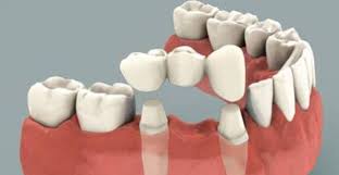 Statistik 2016 kementerian kesihatan malaysia menunjukkan bahawa secara purata jumlah gigi yang ada akan berkurangan dengan peningkatan usia. Gigi Palsu Di Jasad Mayit Konsultasi Agama Dan Tanya Jawab Pendidikan Islam