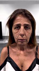 Resultados da Harmonização Facial na Clínica Transformando Faces