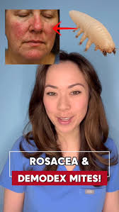 Image result for demodex rosacea