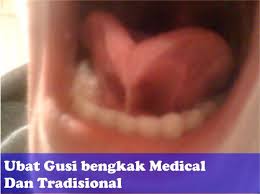 Gigi dan ubat gigi, ubat gigi mu min, ubat gigi darlie, ubat gigi sensodyne, ubat gigi pepsodent, ubat gigi translate google, iklan ubat gigi, tips ajar anak gosok gigi , berus gigi, ubat gigi bagus via ainulmustafa.com. Ubat Gusi Bengkak Medical Dan Tradisional Maklumat Kesihatan