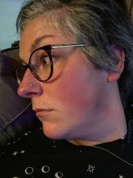 Hi all, I just wanted to ask does anyone else suffer badly with face flear  ups like this at all? I've been having these for years now, we first  thought it was