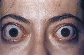 Image result for Proptosis