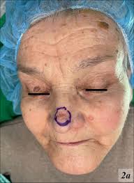 Multiple BCCs after Lisinopril Intake