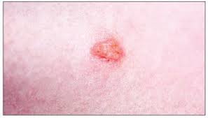 It usually appears as herpes on the back or buttocks, and is sometimes misdiagnosed as shingles. Herpes Simplex Initial And Recurrent Infections