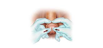 Image result for paraphimosis