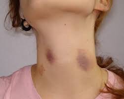 Iron is a vital component of your blood, and when you don't have sufficient of it, you tend to bruise very easily. Hickey Wikipedia