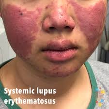 The antibody is named for its ability to bind to the normal dna in patients' cells. Lupus Skin Deep