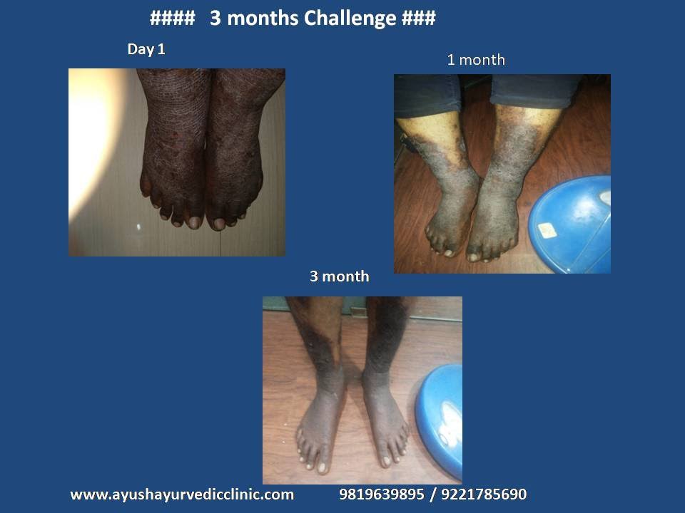 skin disease treatment 20 % off product image