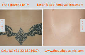 While your tattoo may seem — and it was intended to be — permanent, the wide variety of photos shown in our before and after laser tattoo removal gallery show that the experts at medermis laser clinic are able to completely remove the. Tattoo Removal Mumbai Permanent Laser Tattoo Removal Treatment Cost India The Esthetic Clinics