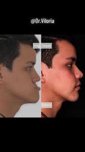 Antes y después de tratamiento de ortodoncia con cirugía ortognatica  #drviloria #ortodoncia #cirugiaortognatica #cirugiaortognaticamaxilofacial  #claseiiiesqueletal #prognatismo #retrognatismo ...