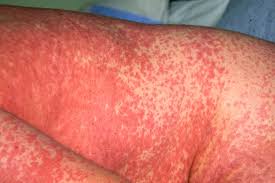 Image result for skin rash acute hiv infection