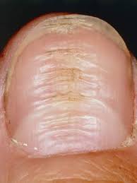 What Are The White Spots On Your Nails Trying To Tell You Everyday Health Nail Health Problems You Nailed It Nail Problems