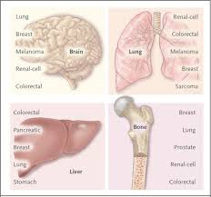 From january 1995 to … Molecular Basis Of Metastasis Abstract Europe Pmc