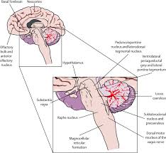 Image result for REM Sleep Behavior Disorder