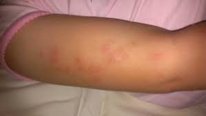 Image result for scabies bite