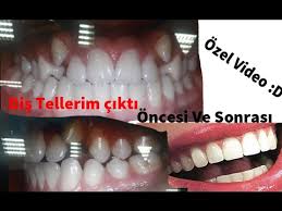 Dis Tellerim Cikti Oncesi Ve Sonrasi Yaptim Vampir Den Insana Donmusum Youtube