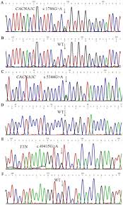 Genetic Analysis Of Sick Sinus Syndrome In A Family Harboring Compound Cacna1c And Ttn Mutations