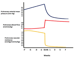 Ventricular Septal Defects