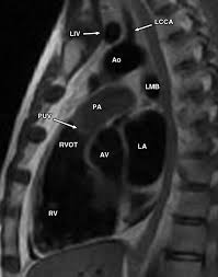 Image result for Cardiac MRI