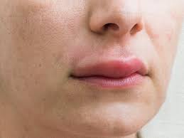 Swollen Upper Lip: Causes And Treatments