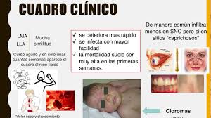 Puede afectar a dos tipos distintos de linfocitos (las células b y . Leucemia Mieloide Aguda Youtube