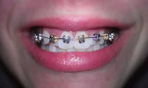 Pin By Jamjuree Kongtiang On Braces Orange And Purple Purple Nose Ring