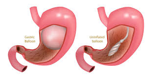 هل تعرف أضرار بالون المعدة ويب طب