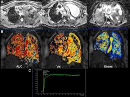 Eric butchart devised the first mesothelioma staging system in 1976, but the technique is not commonly used and is limited in detail. Radiologic Considerations And Standardization Of Malignant Pleural Mesothelioma Imaging Within Clinical Trials Consensus Statement From The Nci Thoracic Malignancy Steering Committee International Association For The Study Of Lung Cancer Mesothelioma
